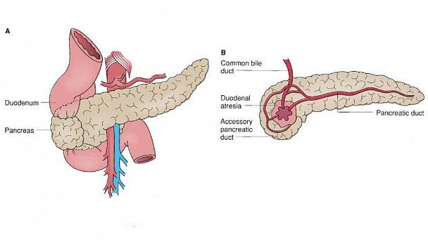Кольцевидная поджелудочная железа у детей: от диагноза до выздоровления